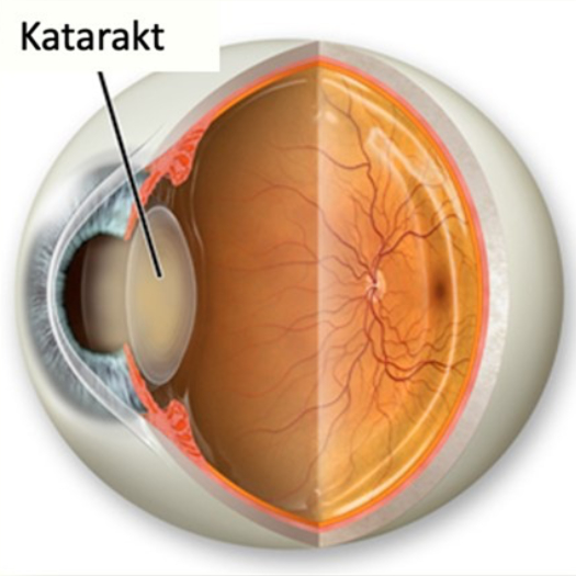 Cataract